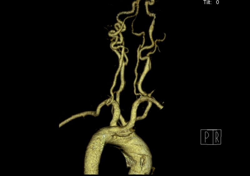 File:Aberrant right subclavian artery (Radiopaedia 19283-19294 3D reconstruction C+ arterial phase 25).jpg