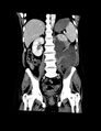 Accessory right inferior hepatic vein (Radiopaedia 33050-34067 Coronal C+ portal venous phase 8).jpg