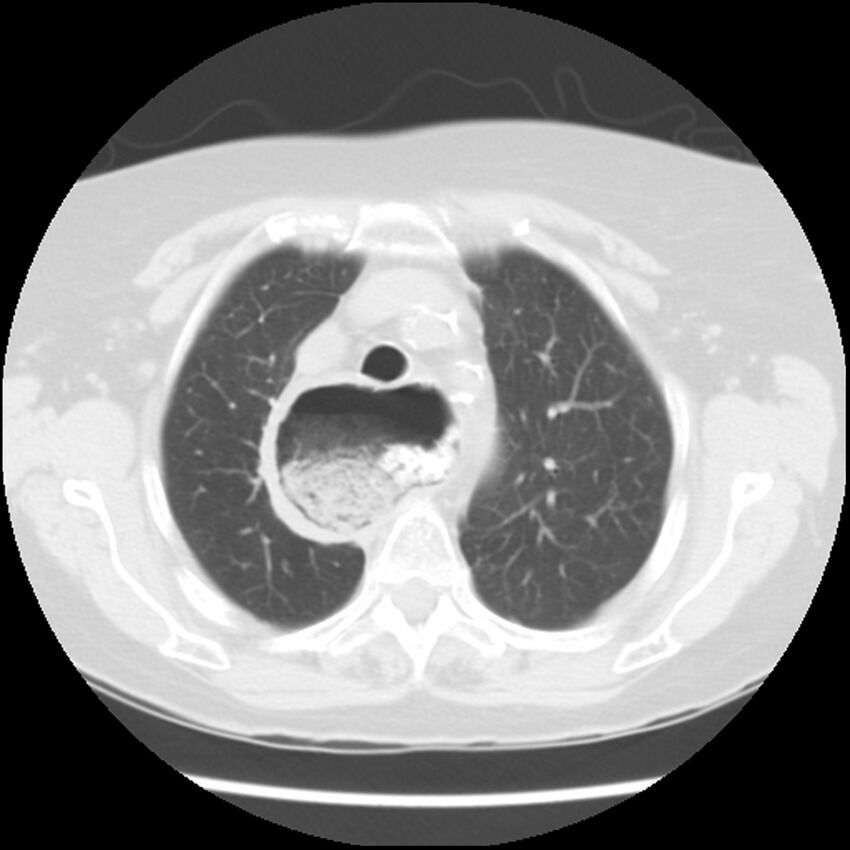 Achalasia (Radiopaedia 44094-47649 Axial lung window 14).jpg