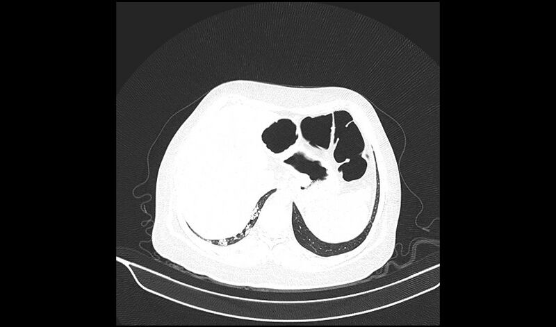 File:Acquired tracheo-esophageal fistula (Radiopaedia 51356-57103 Axial lung window 39).jpg