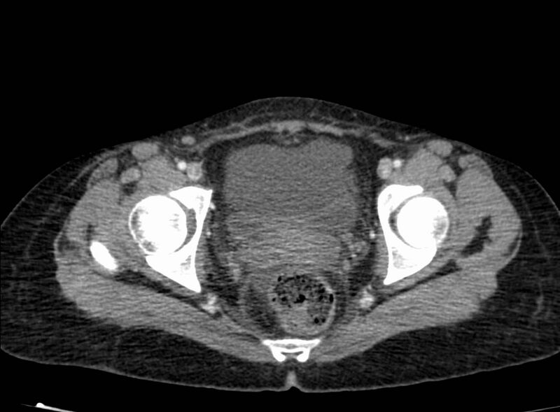 File:Acute Budd-Chiari syndrome (Radiopaedia 60858-68638 Axial C+ portal venous phase 279).jpg