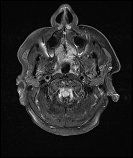File:Acute P1 occlusion with PCA ischemia penumbra (CT perfusion) (Radiopaedia 72084-82590 Axial FLAIR 1).jpg
