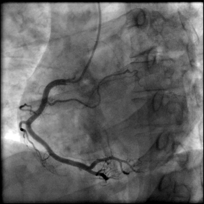 Acute anteroseptal myocardial infarction (Radiopaedia 68409-77946 RAO straight RCA 34).jpg