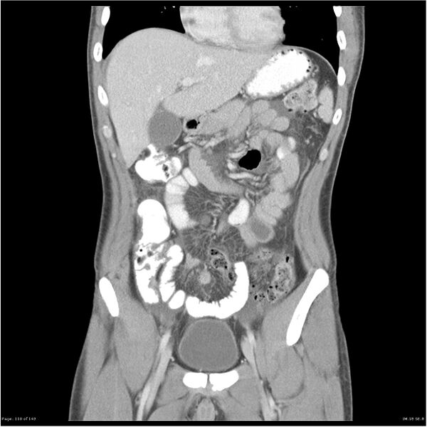 File:Acute appendicitis (Radiopaedia 25364-25615 C+ portal venous phase 7).jpg