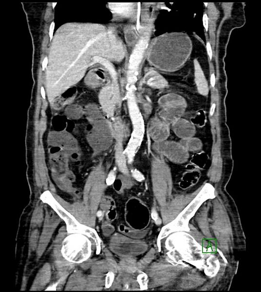 File:Acute arterial mesenteric ischemia (Radiopaedia 78238-90828 Coronal C+ portal venous phase 51).jpg