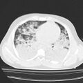 Acute aspiration pneumonitis (Radiopaedia 33605-34703 Axial lung window 57).jpg