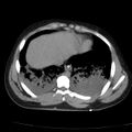 Acute aspiration pneumonitis (Radiopaedia 33605-34703 Axial non-contrast 64).jpg