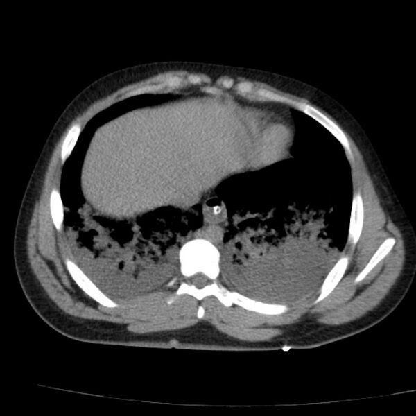 File:Acute aspiration pneumonitis (Radiopaedia 33605-34703 Axial non-contrast 64).jpg