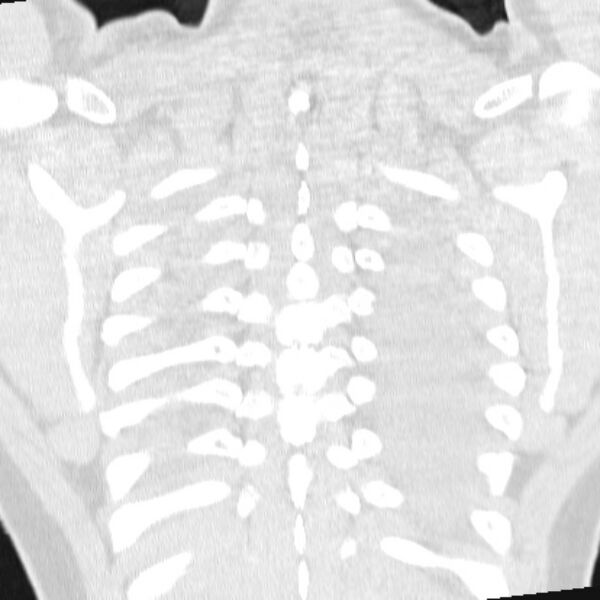 File:Acute aspiration pneumonitis (Radiopaedia 33605-34703 Coronal lung window 70).jpg