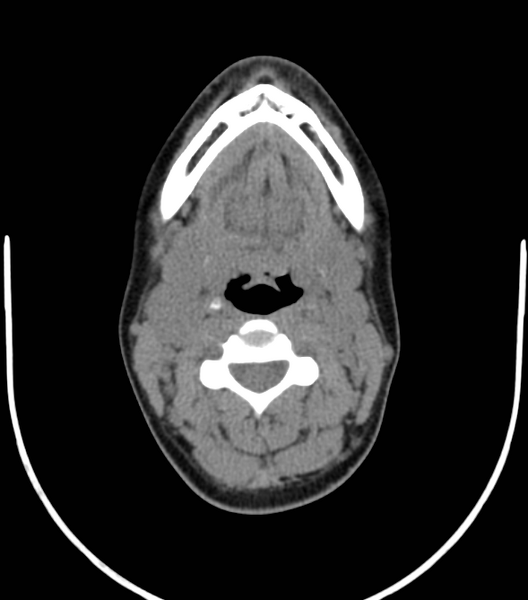 File:Acute bacterial tonsillitis (Radiopaedia 22882-22908 Axial non-contrast 28).png