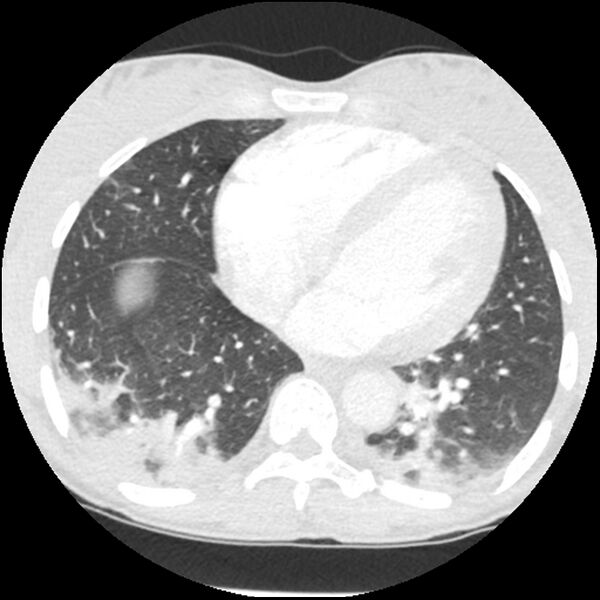 File:Acute chest syndrome - sickle cell disease (Radiopaedia 42375-45499 Axial lung window 132).jpg