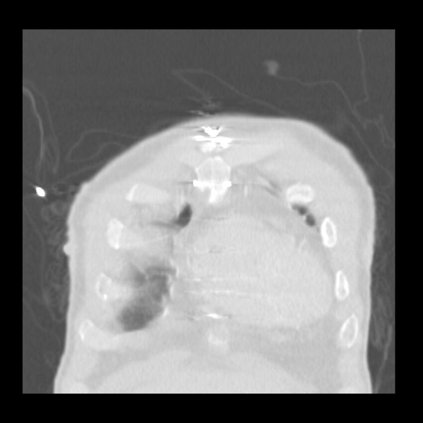 Acute diffuse alveolar hemorrhage (Radiopaedia 41323-44158 Coronal lung window 1).jpg