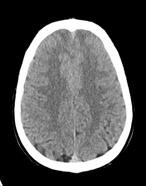 File:Acute disseminated encephalomyelitis (ADEM) (Radiopaedia 65319-74348 Axial non-contrast 23).png
