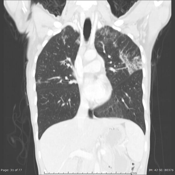 File:Acute eosinophilic pneumonia (Radiopaedia 48211-53073 Coronal 13).jpg