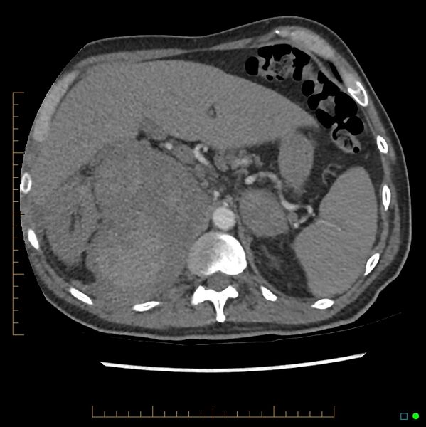 File:Acute hemorrhage into adrenal metastasis from NSCLC (Radiopaedia 43135-46429 Axial C+ CTPA 13).jpg