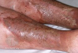 Lipodermatosclerosis (dark thickened skin around ankles)