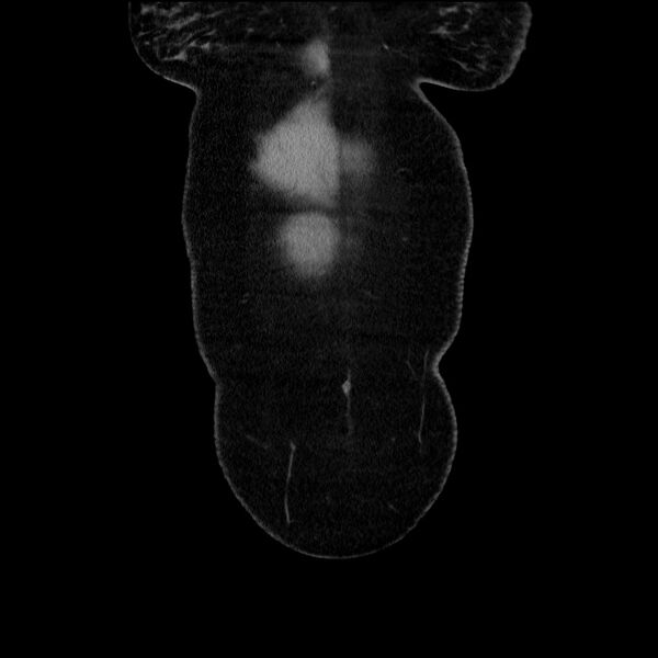 File:Acute pancreatitis (Radiopaedia 69236-79012 Coronal C+ portal venous phase 66).jpg