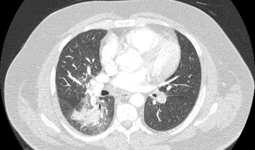 Acute pulmonary embolism with pulmonary infarcts (Radiopaedia 77688-89908 Axial lung window 61).jpg