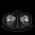Acute pyelonephritis (Radiopaedia 25657-25837 Axial renal parenchymal phase 92).jpg