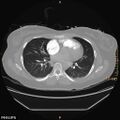 Acute reversible pulmonary hypertension and right heart failure from cocaine toxicity (Radiopaedia 49394-54517 Axial C+ CTPA 6).jpg
