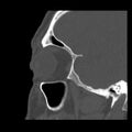 Acute sinusitis (Radiopaedia 23161-23215 Sagittal bone window 16).jpg