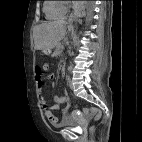 File:Acute tubular necrosis (Radiopaedia 28077-28334 H 51).jpg
