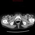 Adenocarcinoma of the colon (Radiopaedia 8191-9039 Axial renal excretory phase 64).jpg
