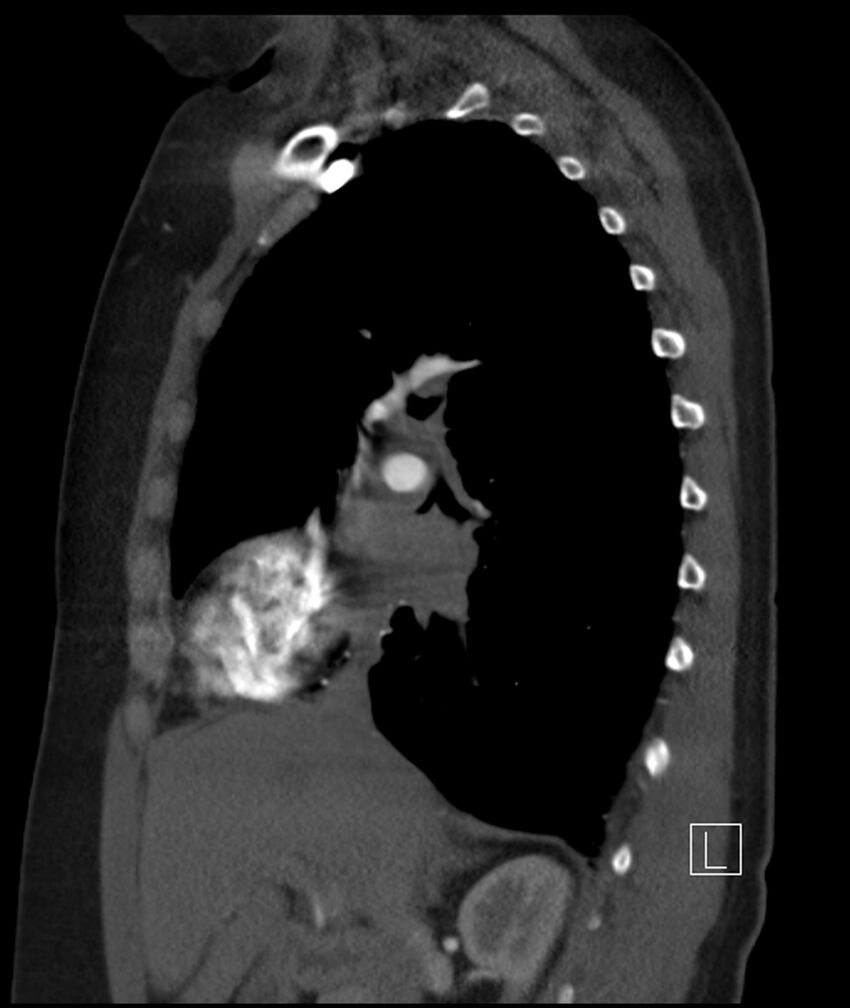 Adenocarcinoma of the lung (Radiopaedia 44205-47803 Sagittal C+ portal venous phase 35).jpg