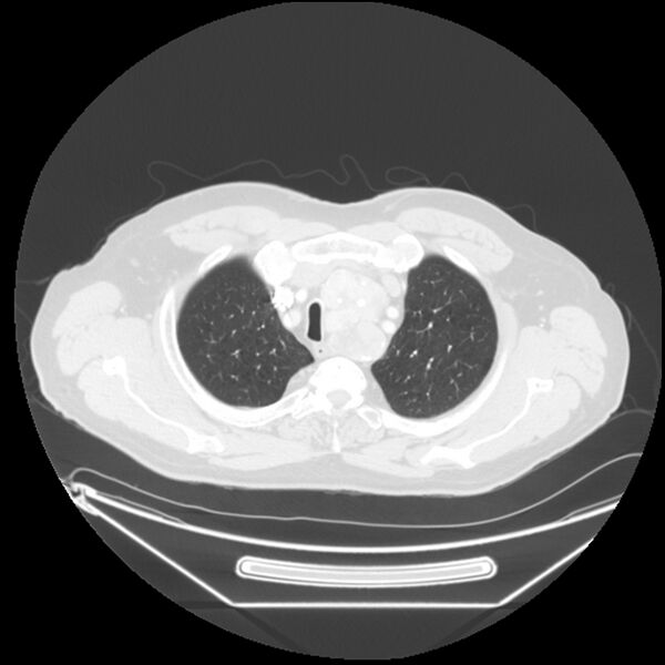 File:Adenocarcinoma of the lung (Radiopaedia 44876-48759 Axial lung window 11).jpg
