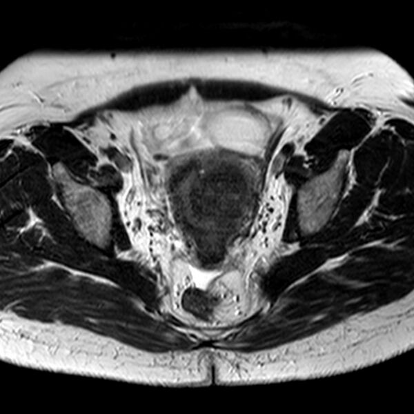 File:Adenomyoma of the uterus (Radiopaedia 9871-10439 Axial T2 16).jpg