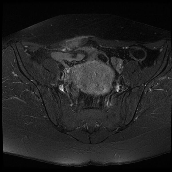 File:Adenomyosis-scar endometriosis (Radiopaedia 65863-75022 Axial T1 C+ fat sat 6).jpg
