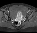 Adenomyosis - ovarian endometriomas (Radiopaedia 67031-76350 Axial T1 C+ fat sat 17).jpg