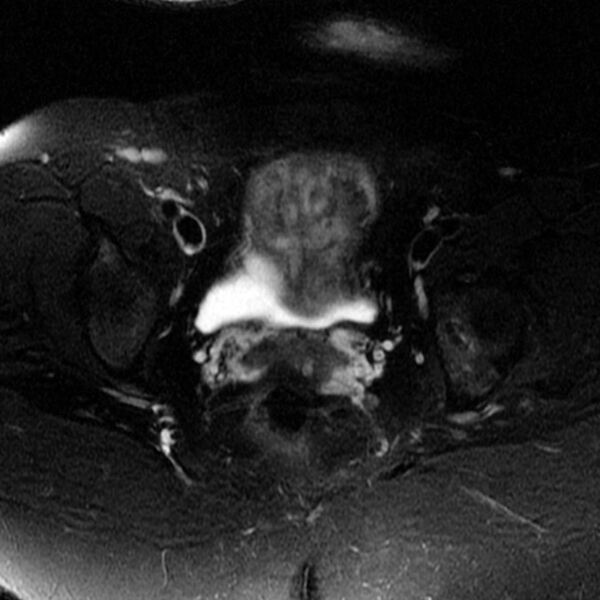 File:Adenomyosis of the uterus (Radiopaedia 9869-10437 Axial T2 5).jpg