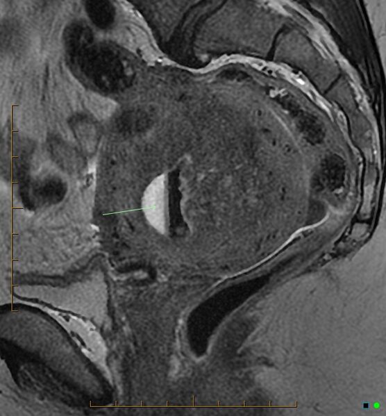 File:Adenomyosis uterus with hematometra (Radiopaedia 45779-50011 Sagittal T2 13).jpg