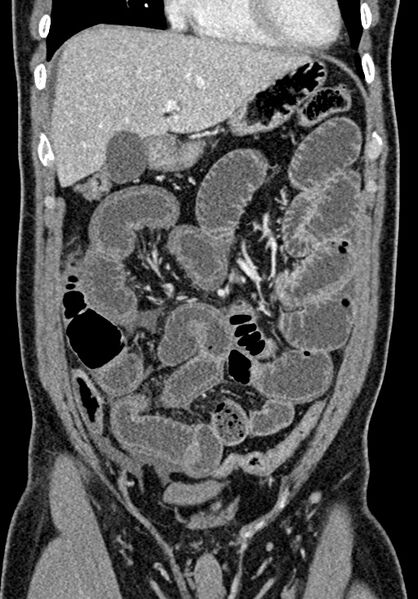 File:Adhesional small bowel obstruction (Radiopaedia 58900-66131 Coronal C+ portal venous phase 103).jpg