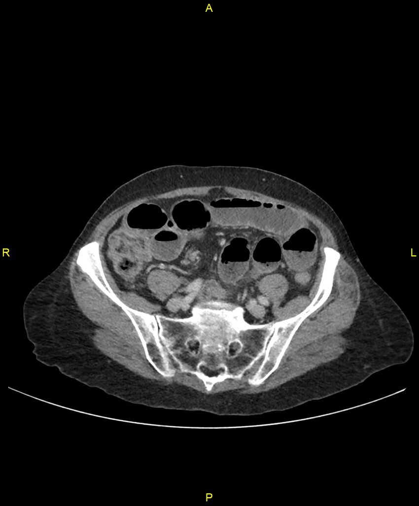 Adhesional small bowel obstruction (Radiopaedia 85402-101024 Axial C+ portal venous phase 205).jpg