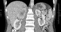 Adrenal pheochromocytoma (Radiopaedia 35133-36726 Coronal C+ portal venous phase 38).jpg