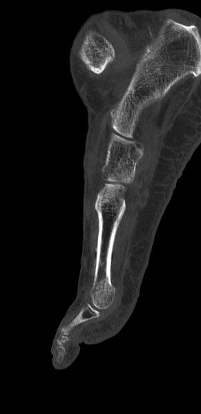 File:Advanced osteomyelitis due to open metatarsal fracture (Radiopaedia 83891-99095 C 17).jpg