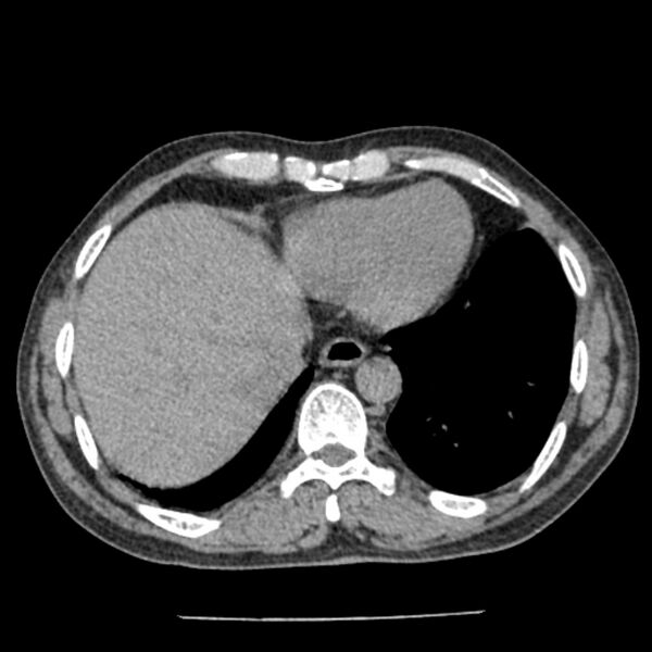 File:Airway foreign body in adult (Radiopaedia 85907-101779 Axial liver window 152).jpg