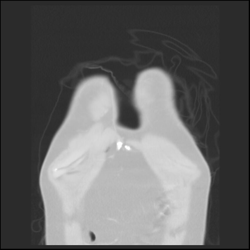Alpha-1-antitrypsin deficiency (Radiopaedia 40993-43722 Coronal lung window 1).jpg