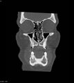 Ameloblastoma (Radiopaedia 18115-17901 Axial bone window 18).jpg