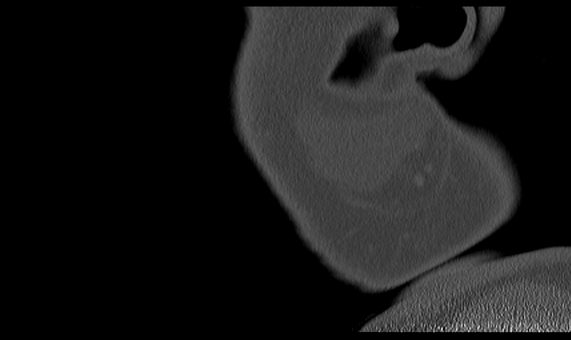 File:Ameloblastoma (Radiopaedia 33677-34806 Sagittal bone window 60).png