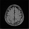 Amnestic syndrome secondary to hypoxic brain injury (Radiopaedia 24743-25004 FLAIR 17).jpg