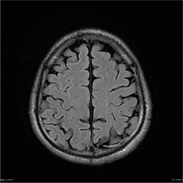 File:Amnestic syndrome secondary to hypoxic brain injury (Radiopaedia 24743-25004 FLAIR 17).jpg