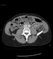 Ampulla of Vater metastasis (Radiopaedia 27820-28069 A 125).jpg