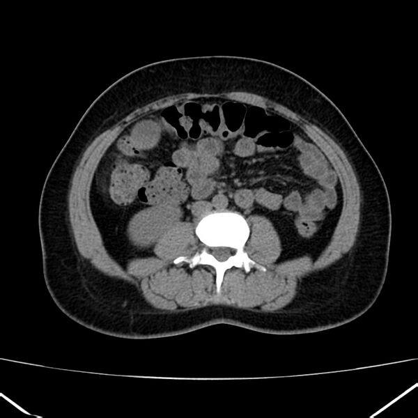 File:Ampullary tumor (Radiopaedia 22787-22816 Axial non-contrast 30).jpg