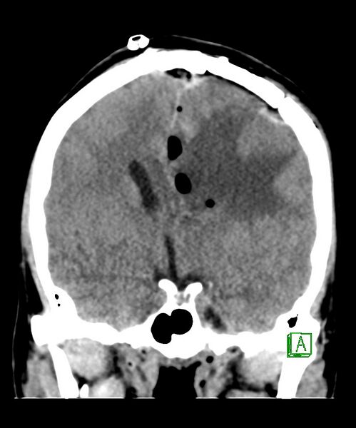 File:Angiomatous meningioma (Radiopaedia 79459-92578 Coronal non-contrast 18).jpg