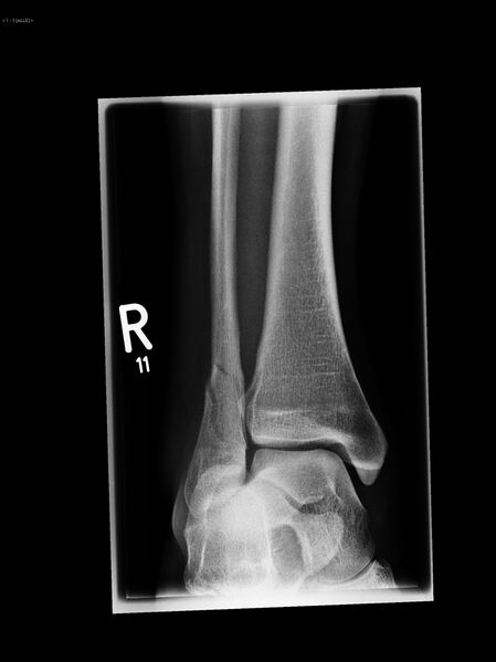File:Ankle fracture - Weber C (Radiopaedia 16119).jpg