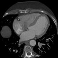 Anomalous origin of left circumflex artery from right coronary sinus (Radiopaedia 72563-83117 A 27).jpg