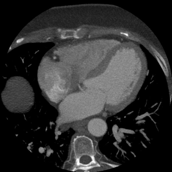 File:Anomalous origin of left circumflex artery from right coronary sinus (Radiopaedia 72563-83117 A 27).jpg